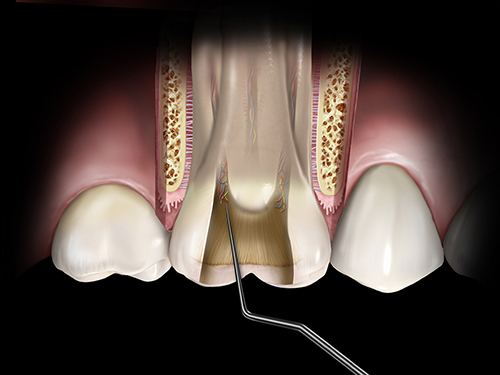 Hu-Friedy Endodontic Black Line