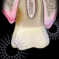 Remove burnished calculus