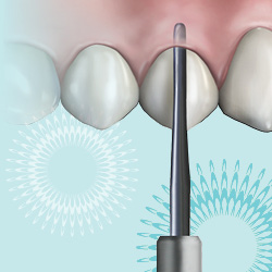 Minimally invasive extraction techniques