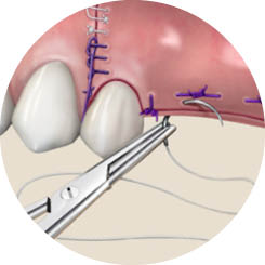 Sutures illustration