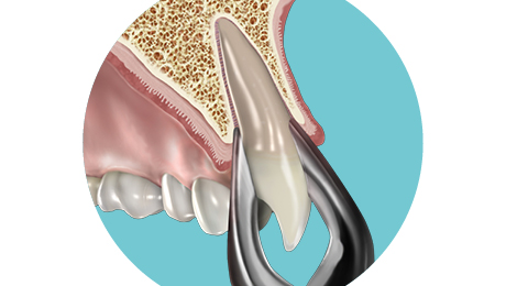 apical forceps teeth removal