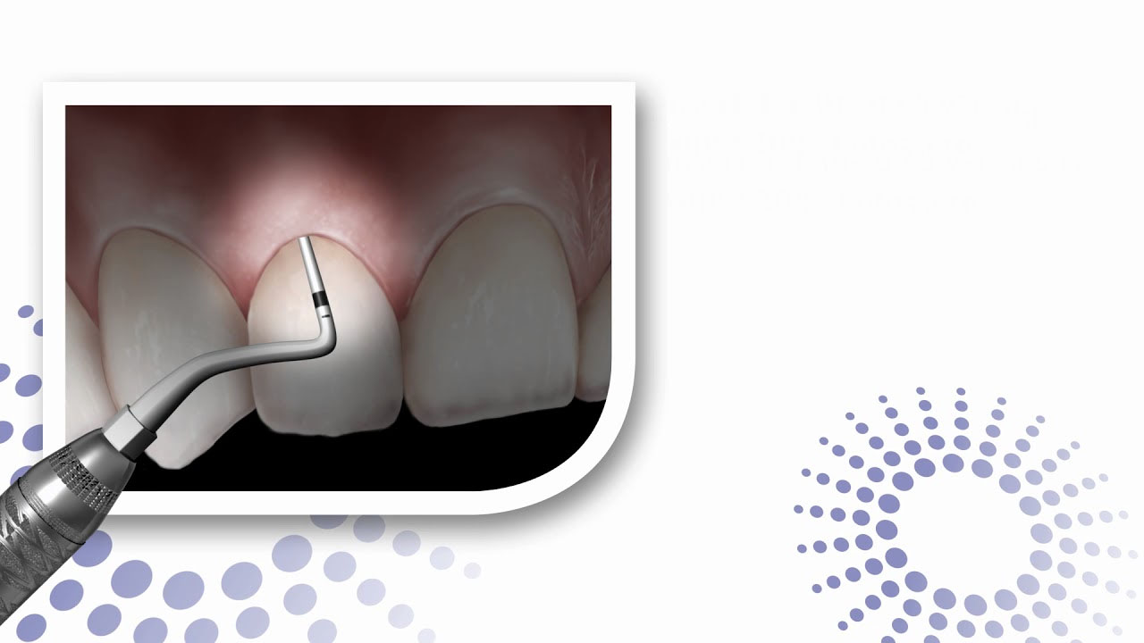 Biotype probe instructional video